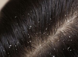 Cara Menghilangkan Ketombe dengan Tanaman Alami